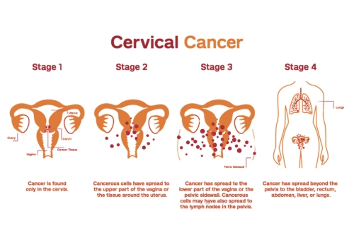 Stages of Cervical Cancer